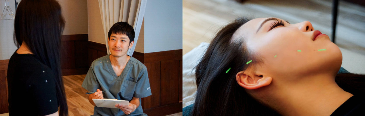 美容鍼を受ける女性