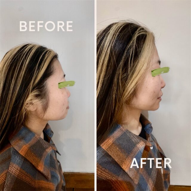 🦉
【美容鍼 1回施術】

むくみが取れるだけで、
ここまで印象は変わります。

✔︎ フェイスラインがスッキリ
✔︎ 頬の位置が整ってシャープな印象に
✔︎ 全体的に引き締まった横顔へ

たった1回でもこの変化✨✨

美容鍼は
・むくみを感じる…
・たるみが気になる…
・ハリがなくなってきた…

といった方にオススメです🦉
⁡
 #郡山 #整体 #腰痛 #鍼灸 #美容鍼