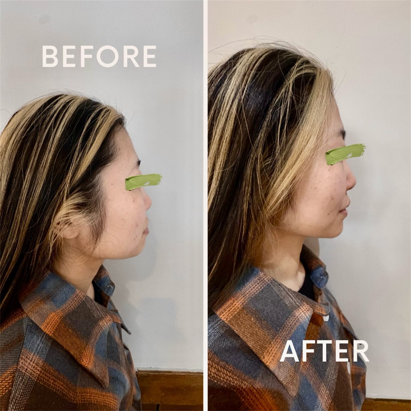 🦉
【美容鍼 1回施術】

むくみが取れるだけで、
ここまで印象は変わります。

✔︎ フェイスラインがスッキリ
✔︎ 頬の位置が整ってシャープな印象に
✔︎ 全体的に引き締まった横顔へ

たった1回でもこの変化✨✨

美容鍼は
・むくみを感じる…
・たるみが気になる…
・ハリがなくなってきた…

といった方にオススメです🦉
⁡
 #郡山 #整体 #腰痛 #鍼灸 #美容鍼