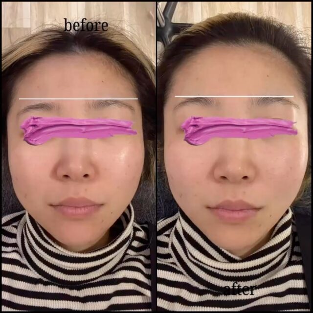 🦉
顔の左右差、気になっていませんか？

「なんかバランスが違う気がする…」
そんな違和感、感じている方も多いです。

"美容鍼"をすると
✔︎ 左右のバランスが整う
✔︎ 頬の位置が上がる
✔︎ スッキリした印象に

強く引き上げるのではなく、自然に整っていくのが特徴です。

お気軽にご相談ください📩
⁡
 #郡山 #美容鍼 #リフトアップ #シワ #むくみ