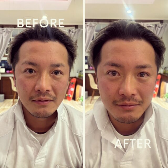 🦉
たった1回でも、ここまで変わります。

✔︎ フェイスラインがスッキリ
✔︎ 頬の位置が上がって立体感アップ
✔︎ 目まわりが軽くなってスッキリした印象に

そして実は、
頬の位置が上がることで
ほうれい線も目立ちにくくなります✨️

「なんとなく疲れて見える…」
そんな方にオススメです🌿.∘
⁡
 #郡山 #整体 #腰痛 #鍼灸 #美容鍼