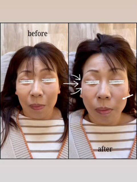 🦉
"だれもが年齢とともに気になってくるお悩み"

「目の下のたるみ」
「ほうれい線」
「フェイスラインのもたつき」

施術後は
✔︎ 目元がスッキリ
✔︎ フェイスラインが引き締まった印象に

ご本人も変化を実感✨

美容鍼は、年齢に関係なく
「今の自分を少しでも良くしたい」と思った時が始めどきです。

「ちょっと気になる…」そんな方はお気軽にご相談ください🦉
⁡
 #郡山 #美容鍼 #たるみ #むくみ #整体