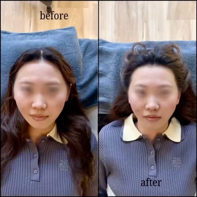 🦉
美容鍼のビフォーアフター📸

「なんか左右違う気がする…」
その違和感、気のせいじゃありません。

原因は
・噛みグセや食いしばり
・表情筋の使い方の偏り（よく使う側・使わない側）
・姿勢の崩れによる歪み

✔︎ 左にズレていた顎 → 中心へ
✔︎ 口元のバランスが整う
✔︎ フェイスラインが引き締まりシャープに

さらに
・頬の高さの左右差が改善
・口角の位置が自然に
・もたつきが減ってスッキリした印象に

“なんとなく気になる”は、整えるサインです。

GWで少し時間がある今、
お顔のバランスを整えるケアをしてみませんか？👌

気になる方はお気軽にご相談ください📩

#郡山　#美容鍼　#整体　#小顔　#腰痛